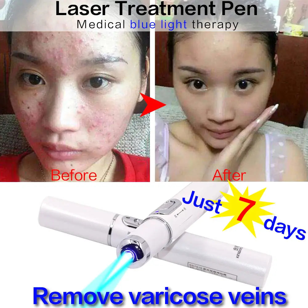 Appareil de beauté à lumière bleue pour le visage, élimination des rides et de l'acné, stylo laser, élimination des taches cutanées, anti-varices, effaceur de veines araignées, traitement médical